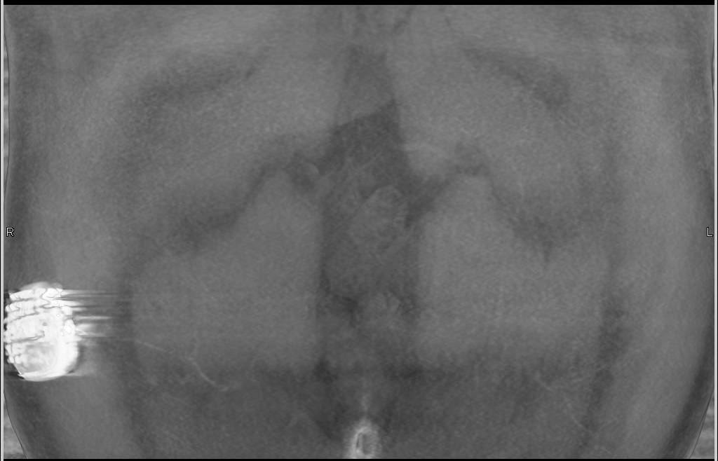 Median Arcuate Ligament Syndrome with Narrowed Celiac Artery and Prominent Gastroduodenal Artery (GDA) - CTisus CT Scan