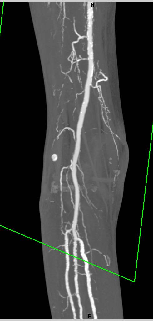 CTA Run Off with Peripheral Vascular Disease (PVD) - CTisus CT Scan