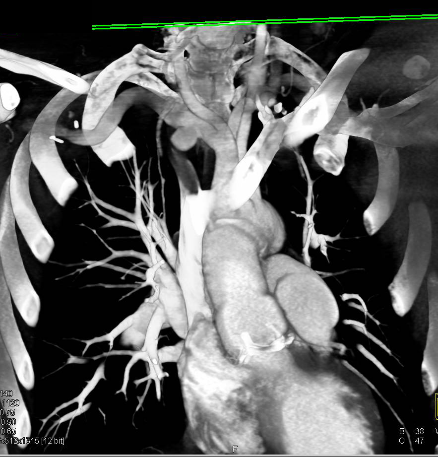 Right Subclavian Artery Aneurysm - CTisus CT Scan