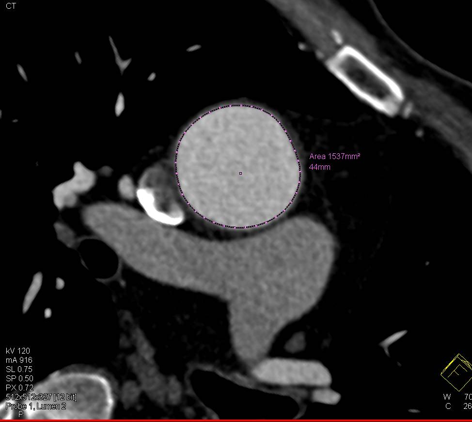 Dilated Root with Center Line Measurement - CTisus CT Scan