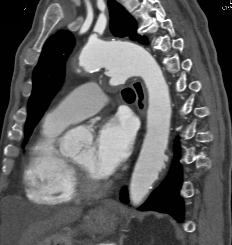 Ulcerating Ductus Aneurysm - CTisus CT Scan