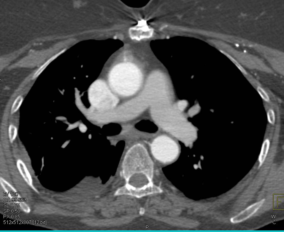 Patent Right Axillary Graft and Occluded Left Axillary Graft - CTisus CT Scan