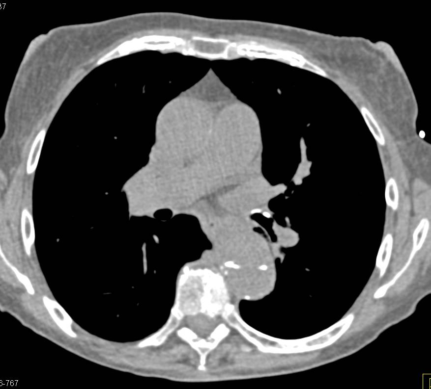 Type B Dissection and Endovascular Stent in Abdominal Aorta - CTisus CT Scan