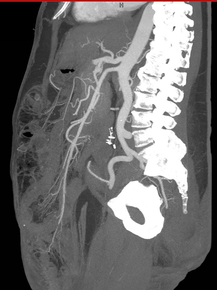 Normal Superior Mesenteric Artery (SMA) on MIP View - CTisus CT Scan