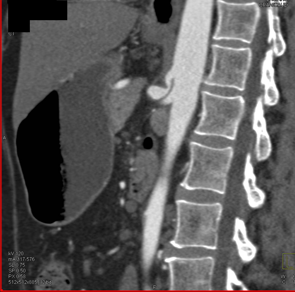 Compressed Celiac Artery with Median Arcuate Ligament Syndrome and Left Renal Artery Aneurysm - CTisus CT Scan