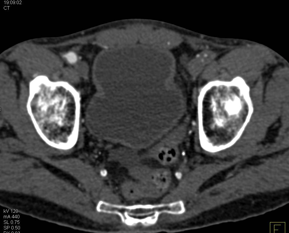 CTS with Peripheral Vascular Disease - CTisus CT Scan