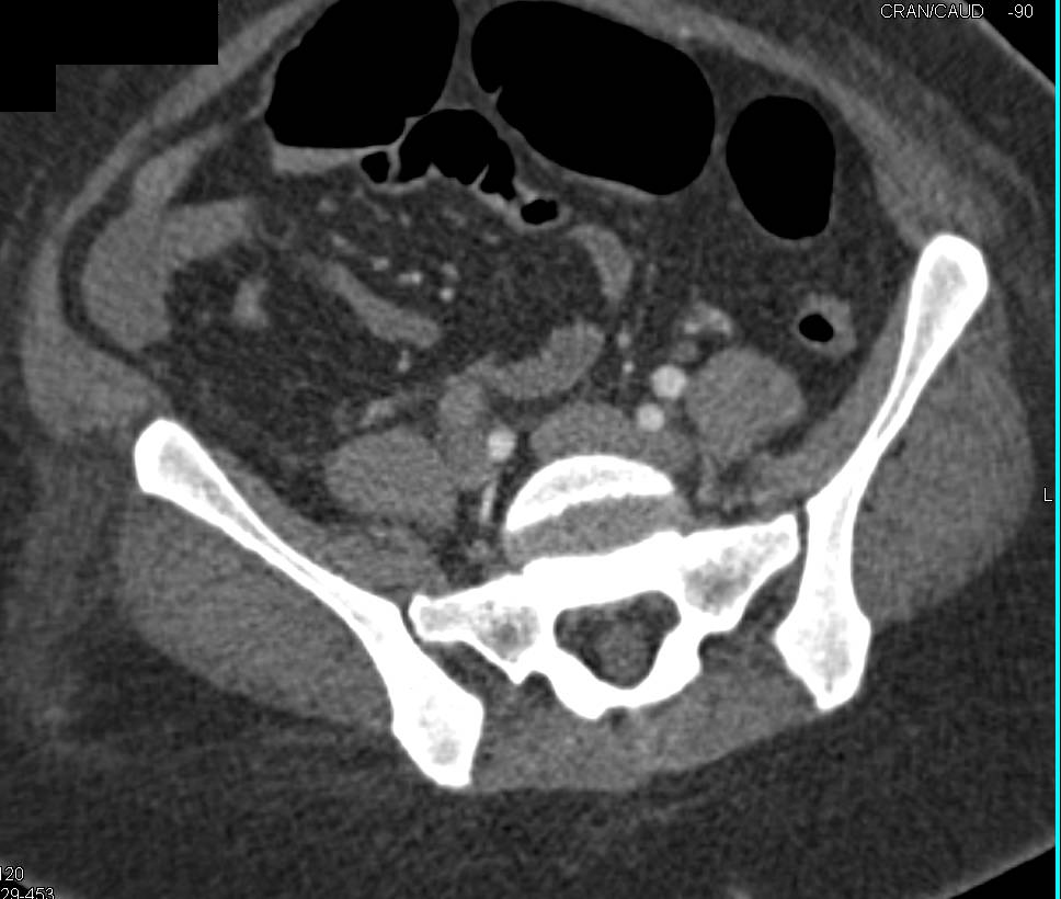 CTA with Occluded Superficial Femoral Artery (SFA)-Popliteal Artery Bypass Graft - CTisus CT Scan