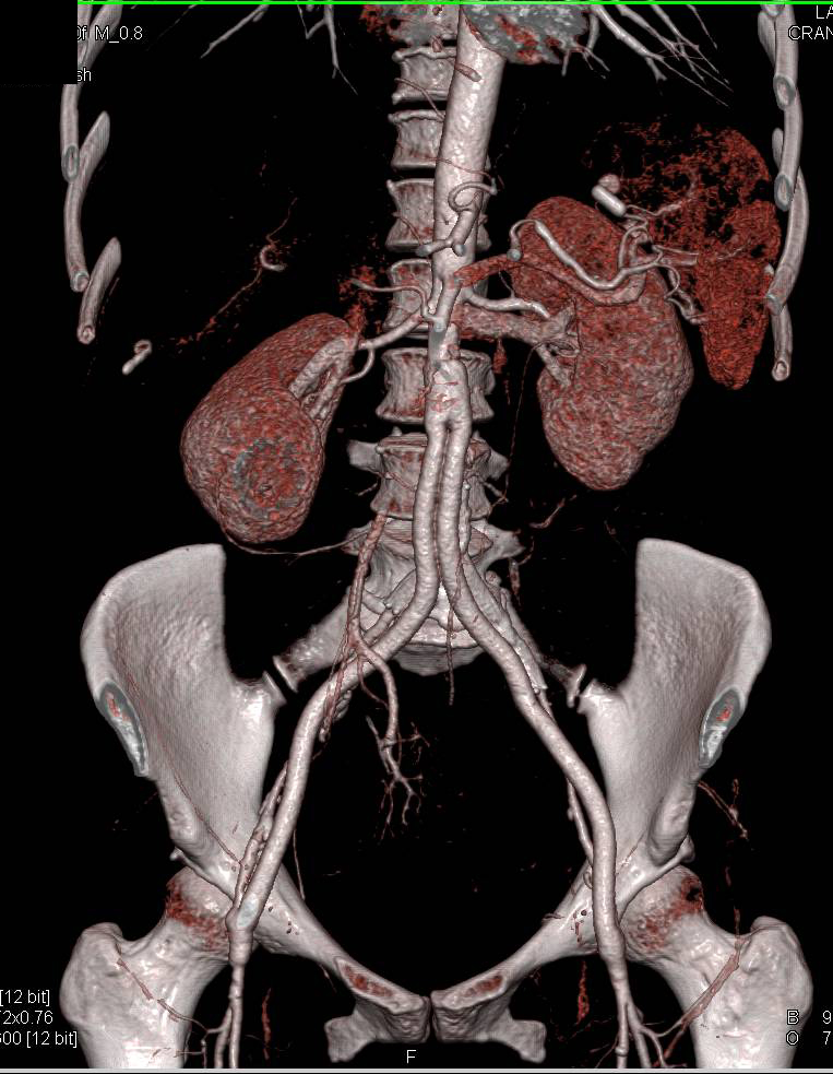 Aorto-Femoral Bypass Grafts and Runoff with Peripheral Vascular Disease (PVD) Nicely Demonstrated in 3D - CTisus CT Scan