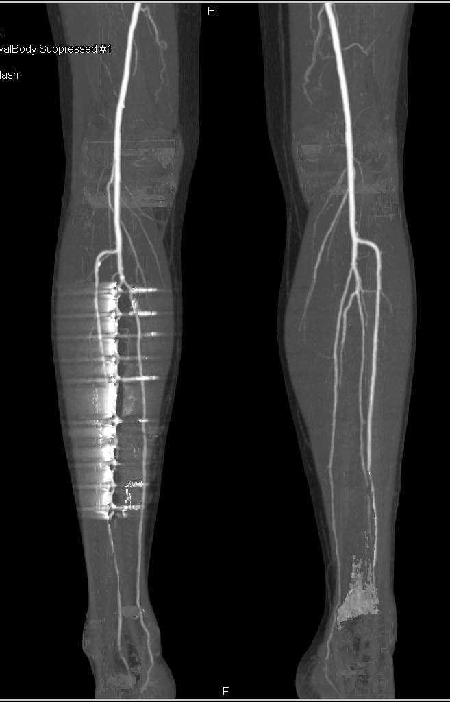 Run-off Study with Peripheral Vascular Disease - CTisus CT Scan