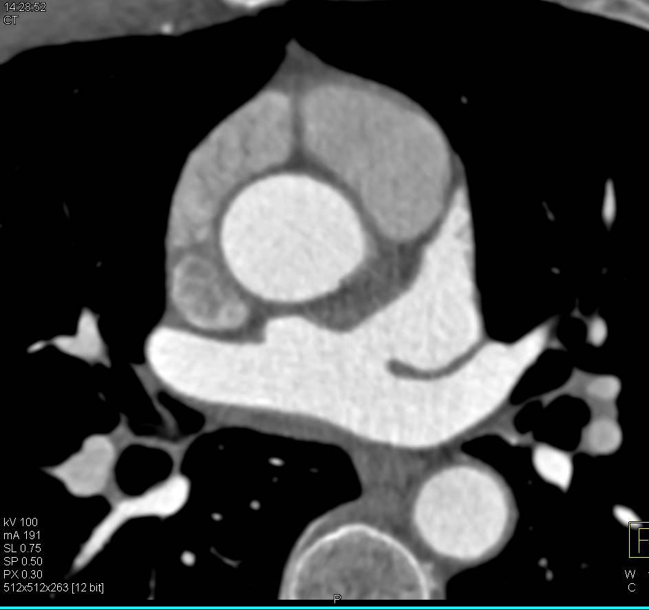 Normal Left Atrium - CTisus CT Scan