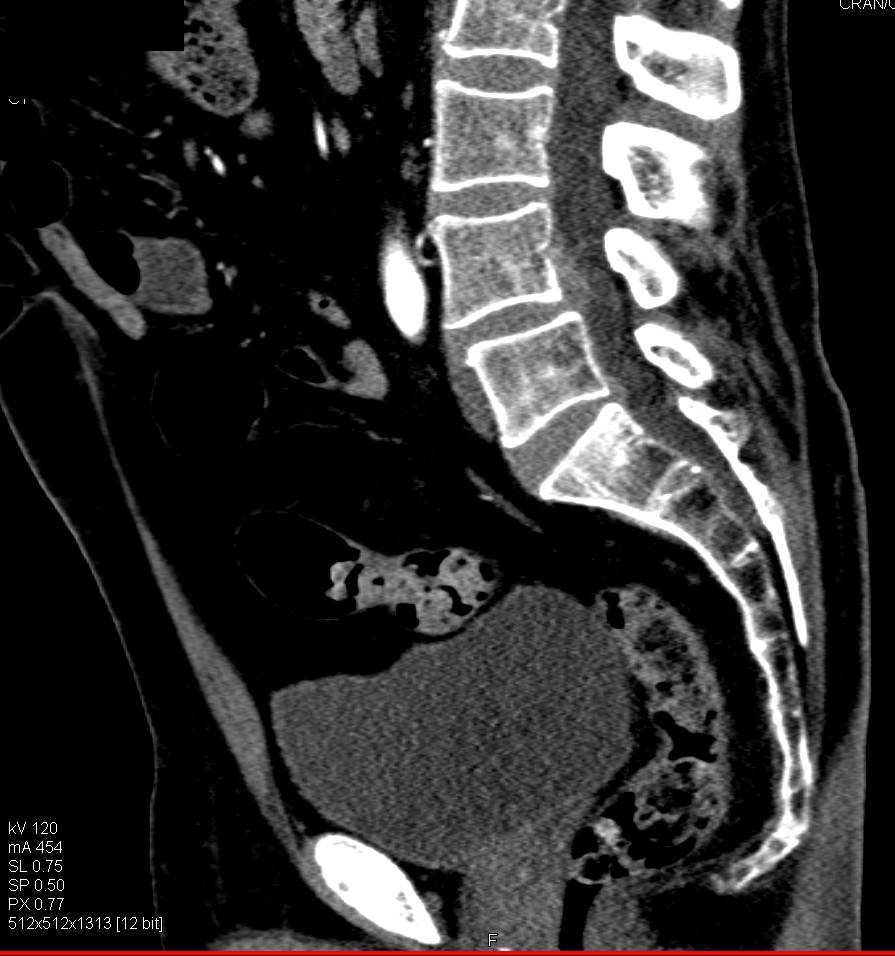 Normal CTA of the Pelvis and Thigh with Bone Removal - CTisus CT Scan