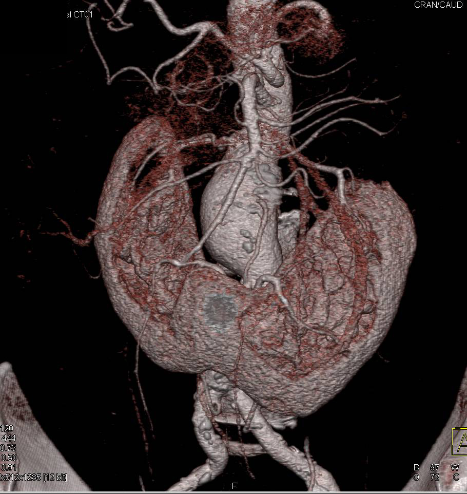 Horseshoe Kidney in a Patient with an Abdominal Aortic Aneurysm - CTisus CT Scan