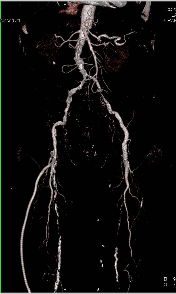 Peripheral Vascular Disease (PVD) with Graft from Superficial Femoral Artery (SFA) to Anterior Tibial Artery. Significant Vascular Pathology - CTisus CT Scan