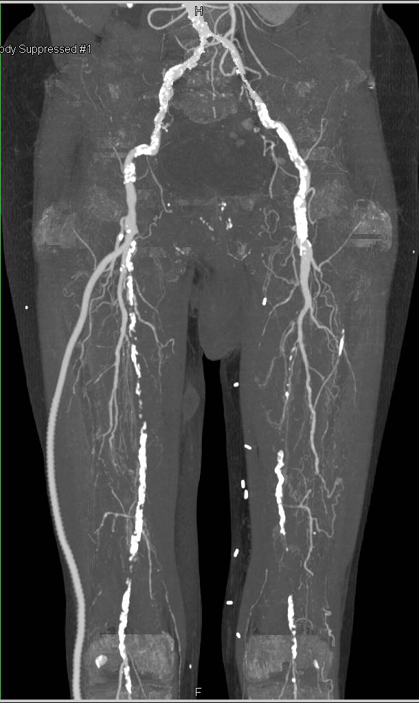 Superficial Femoral Artery (SFA) to Anterior Tibial Artery Bypass in a Patient with Severe Peripheral Vascular Disease - CTisus CT Scan