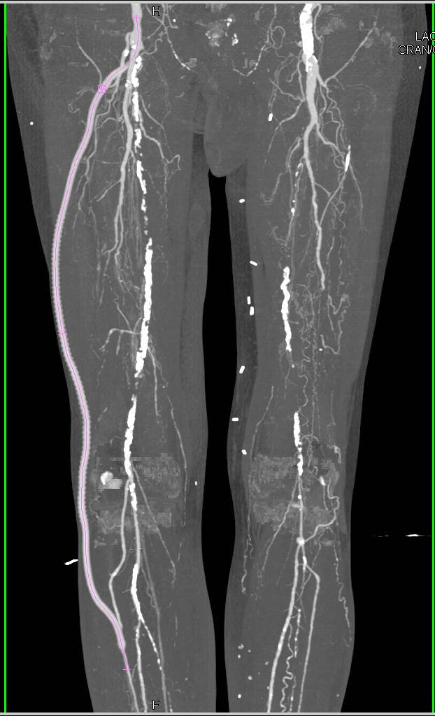 CTA Runoff with Dual Energy CT for Bone Removal - CTisus CT Scan