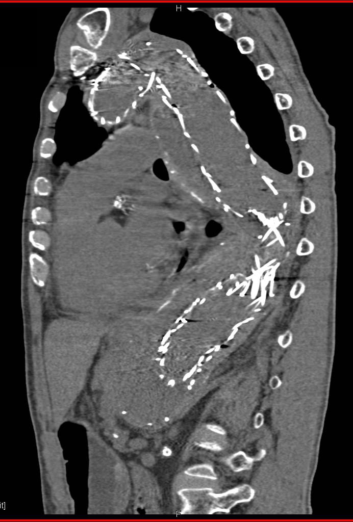 Endovascular Stent Without Endoleak - CTisus CT Scan