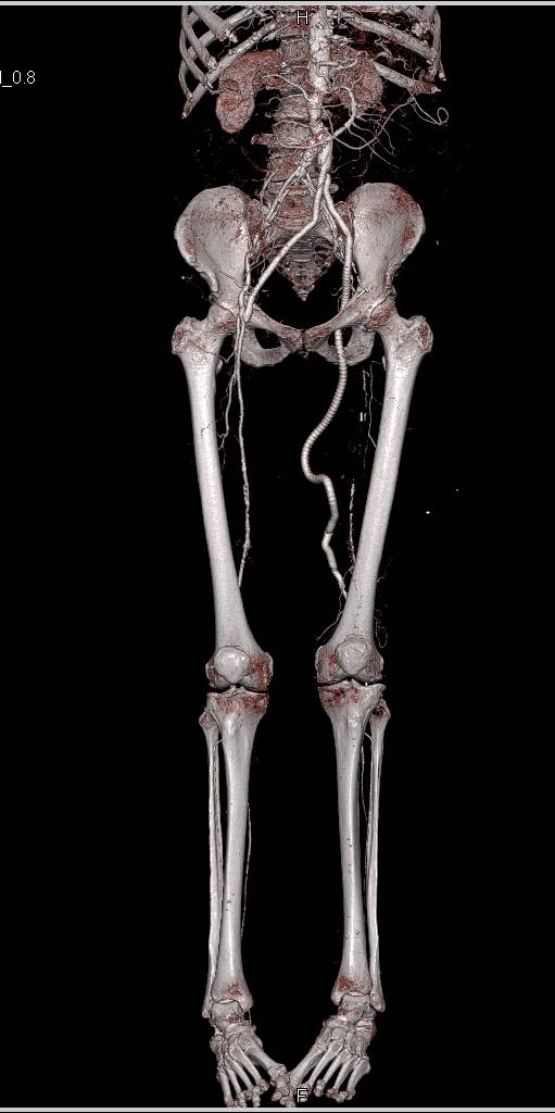 CTA Runoff with Vascular Grafts and Peripheral Vascular Disease (PVD) - CTisus CT Scan