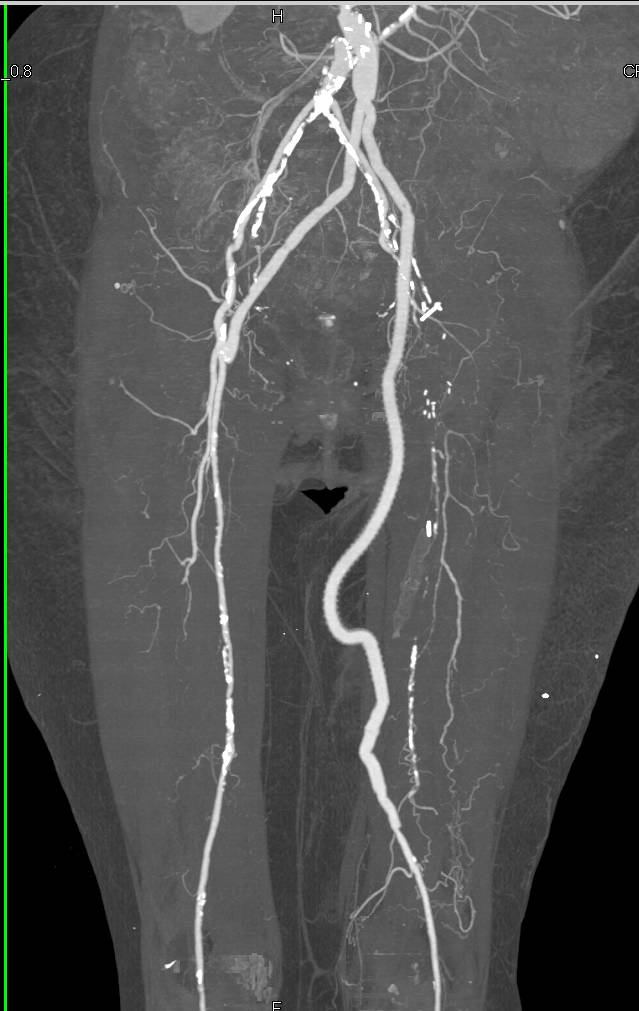 CTA Runoff with Bilateral Vascular Grafts - CTisus CT Scan