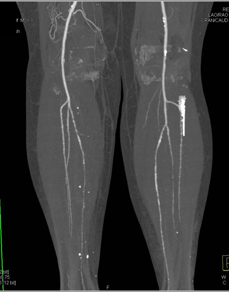 CTA Runoff with Multiple Grafts Including Left Superficial Femoral Artery (SFA) to Anterior Tibia Artery - CTisus CT Scan