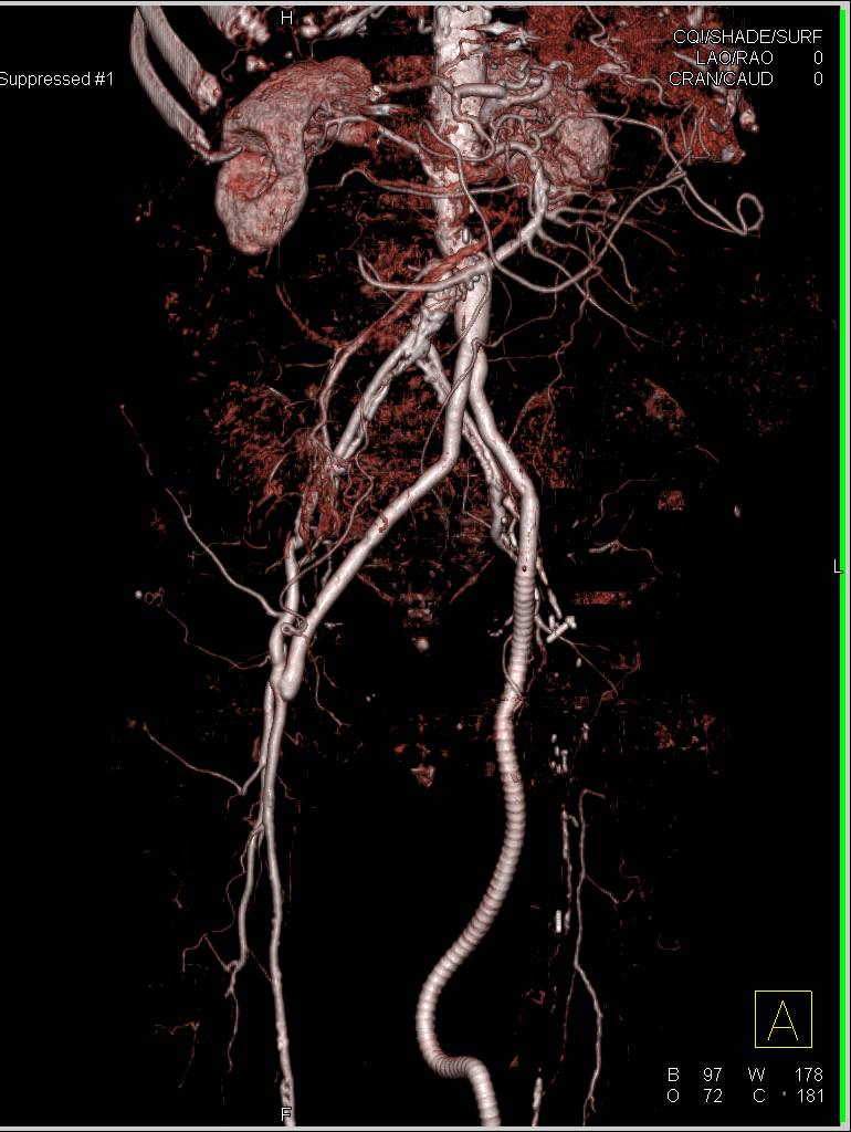 CTA with Vascular Grafts - CTisus CT Scan