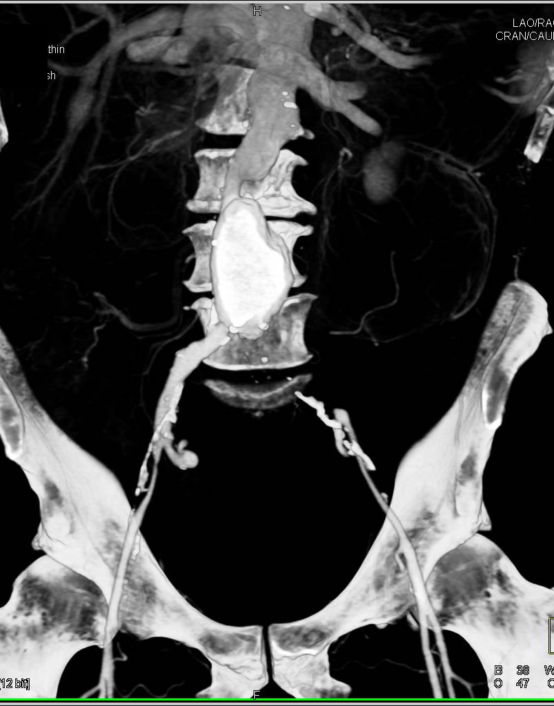 AAA with Occluded Left Common Iliac Artery - CTisus CT Scan