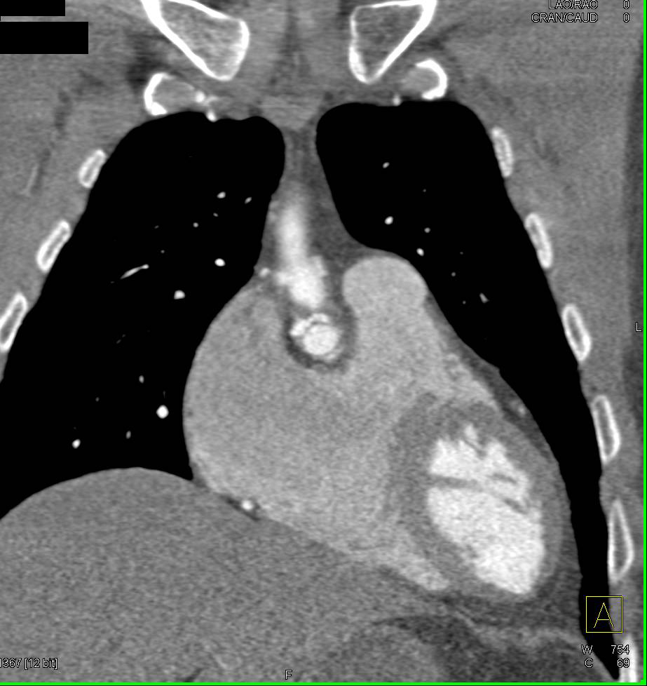 Marfan Syndrome with Aortic Root Repair and Dilated Reimplanted Coronary Arteries - CTisus CT Scan