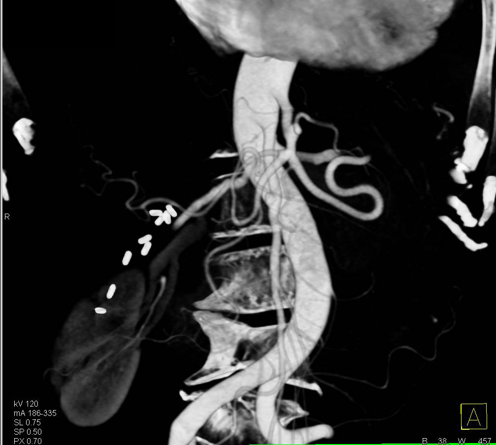 Focal Stenosis in Superior Mesenteric Artery (SMA) due to Vasculitis - CTisus CT Scan