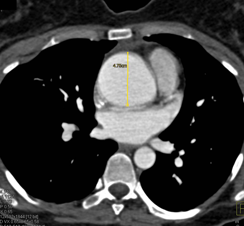 Loeys-Dietz Syndrome with Dilated Aortic Root and Tortuous Carotid Arteries - CTisus CT Scan