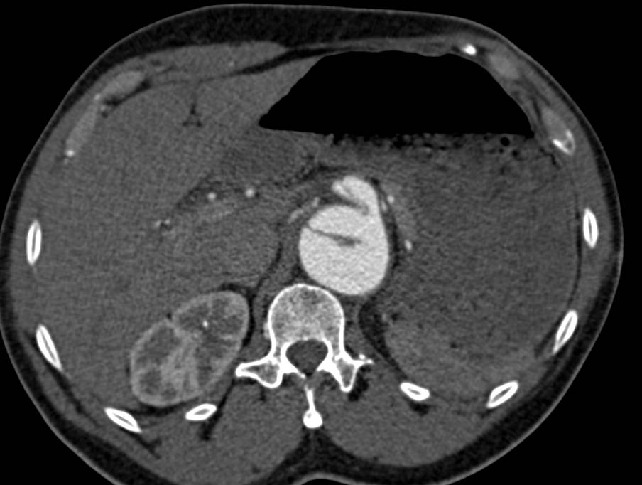 Aortic Dissection Which Extends into the Celiac and SMA - CTisus CT Scan