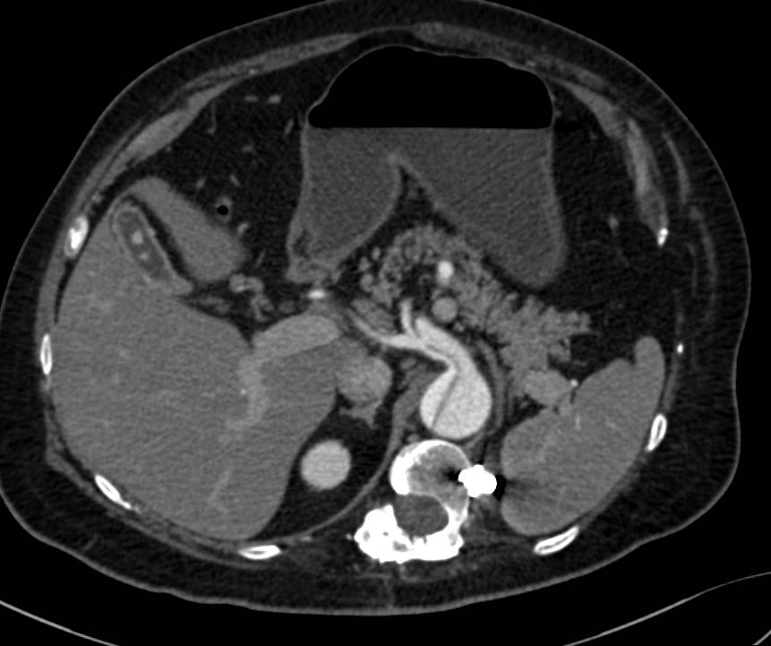 Aortic Dissection Extends into the Celiac Artery - CTisus CT Scan