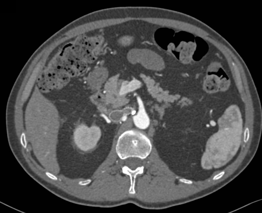 Inferior Vena Cava (IVC) Stent with IVC Reconstruction with 3D Mapping - CTisus CT Scan