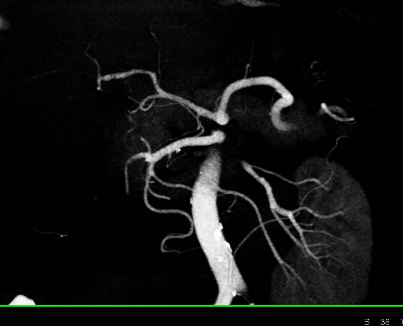 Normal Hepatic Artery - CTisus CT Scan