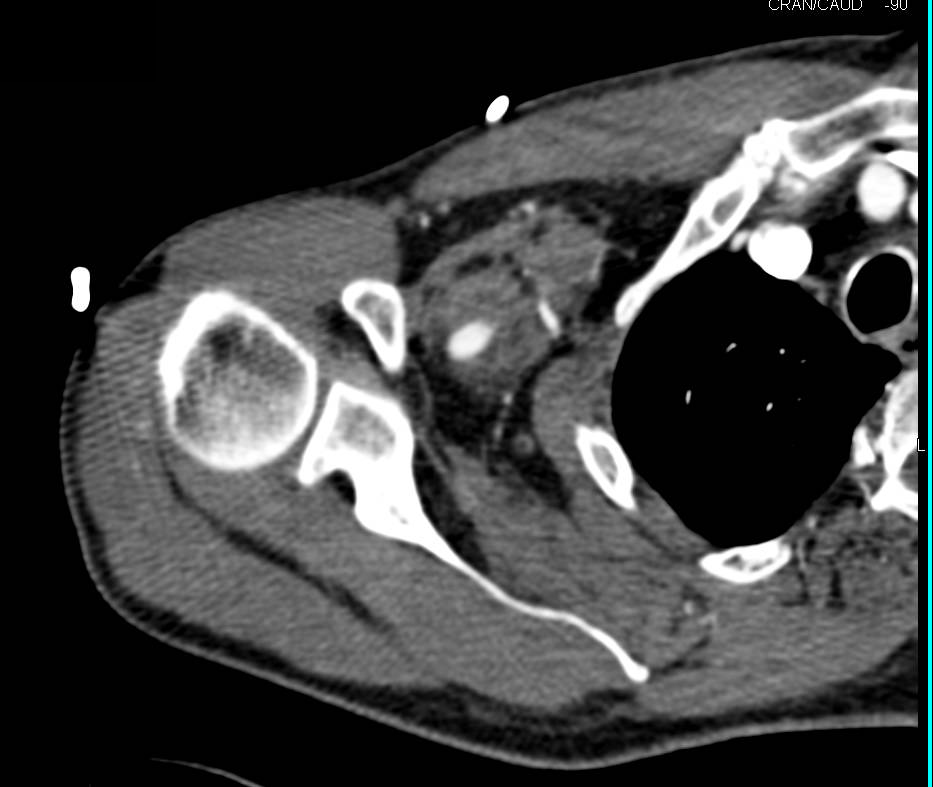 Normal Arterial Anatomy in Upper Extremity - Vascular Case Studies