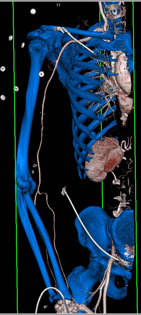 Normal Arterial Anatomy in Upper Extremity - Vascular Case Studies