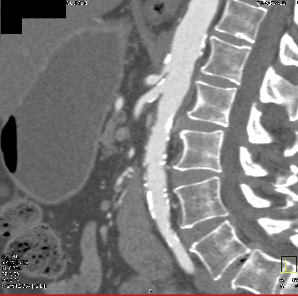 Celiac Stenosis - CTisus CT Scan