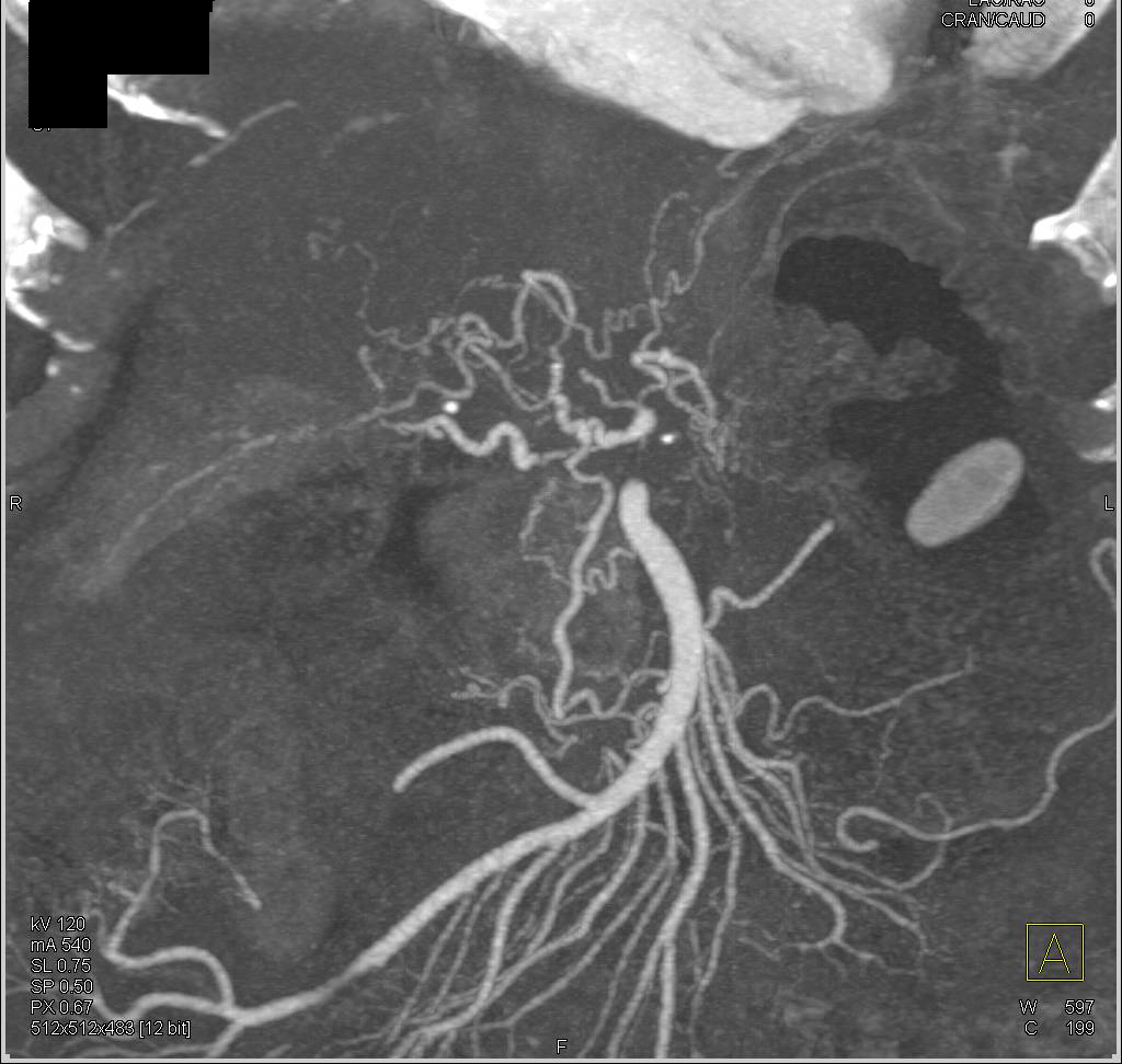 Irregularity of the Hepatic Artery and Its Branches - CTisus CT Scan