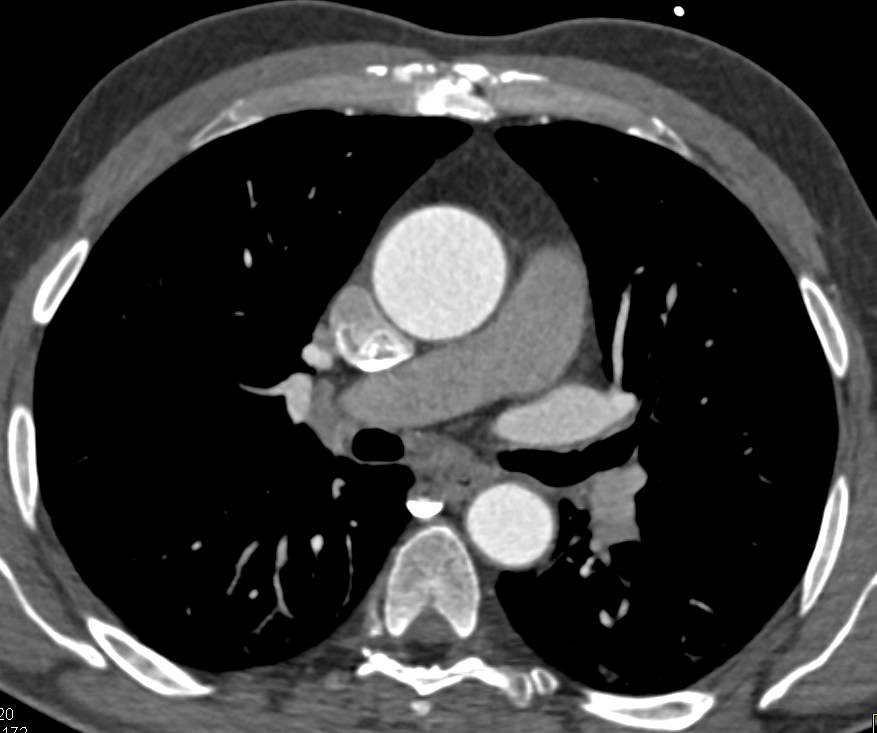 Mildly Dilated Aortic Root and Ascending Aorta - CTisus CT Scan