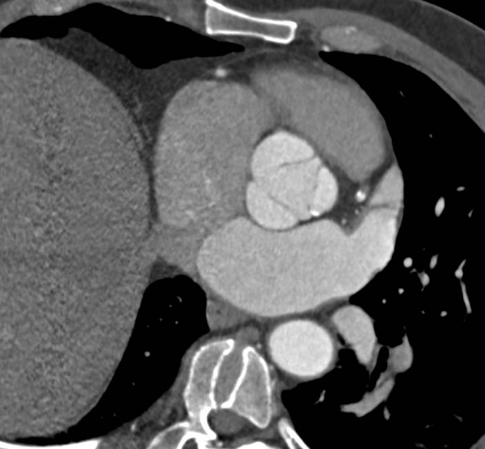 mildly-dilated-aortic-root-and-ascending-aorta-vascular-case-studies