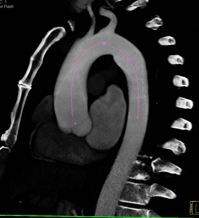 mildly-dilated-aortic-root-and-ascending-aorta-vascular-case-studies