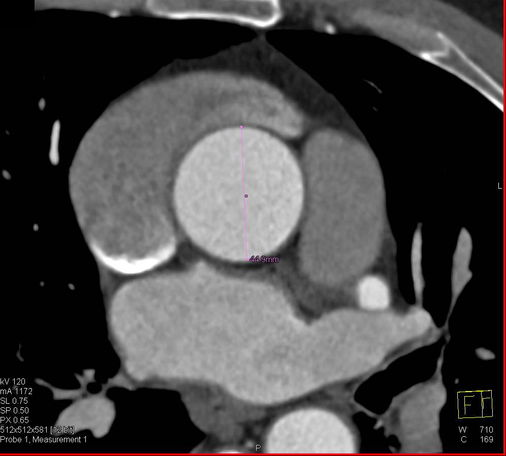 what-is-an-enlarged-aortic-root