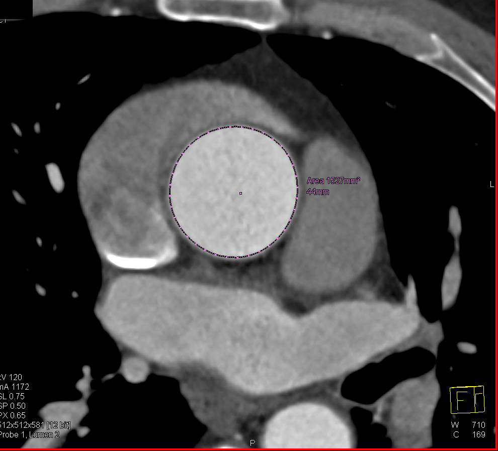 Mildly Dilated Aortic Root Meaning