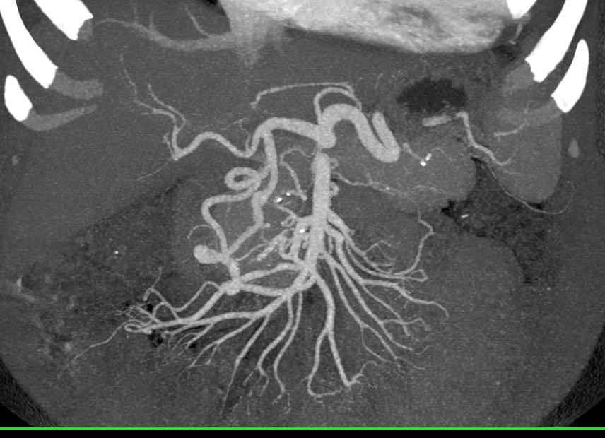 Prominent Gastroduodenal Artery (GDA) in a Patient with Celiac Artery Stenosis - CTisus CT Scan