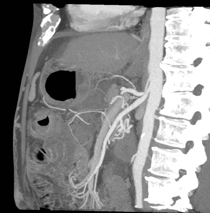 Median Arcuate Ligament Syndrome with Narrowed Celiac Artery - CTisus CT Scan