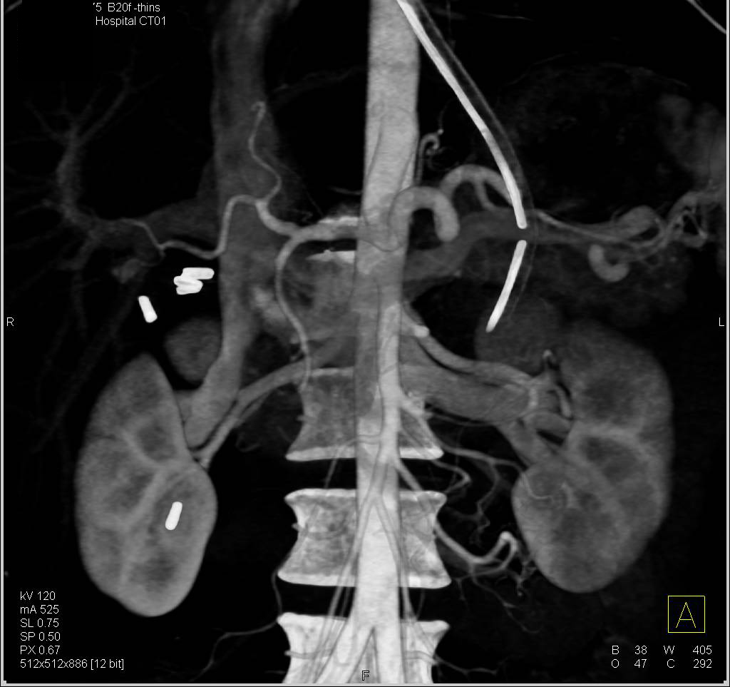 Celiac and Superior Mesenteric Artery (SMA) Vascular Mapping - CTisus CT Scan