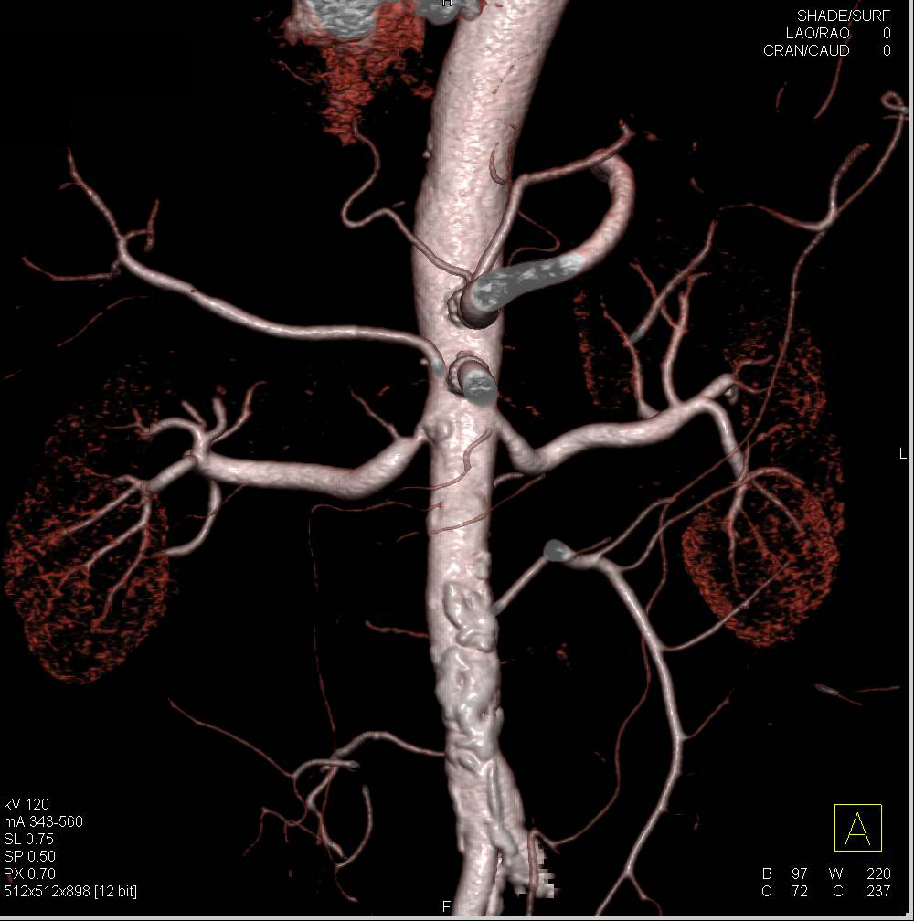 CTA of Patent Stent in Superior Mesenteric Artery (SMA) in 3D - CTisus CT Scan