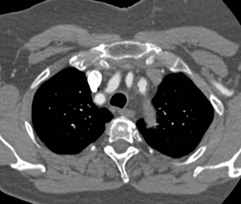 Ulcerating Plaque in Descending Aorta in 3D Displays - CTisus CT Scan