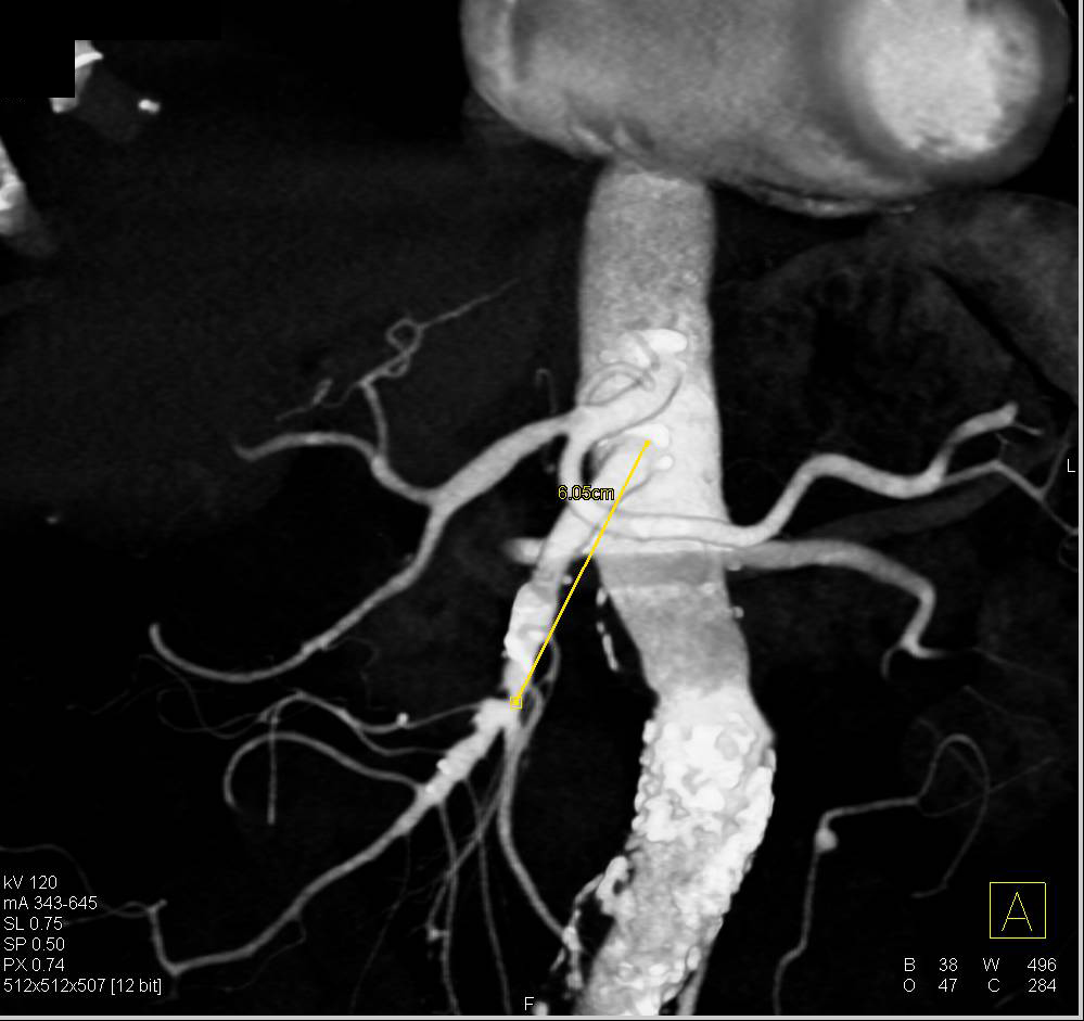 Superior Mesenteric Artery (SMA) Stenosis due to Plaque - CTisus CT Scan