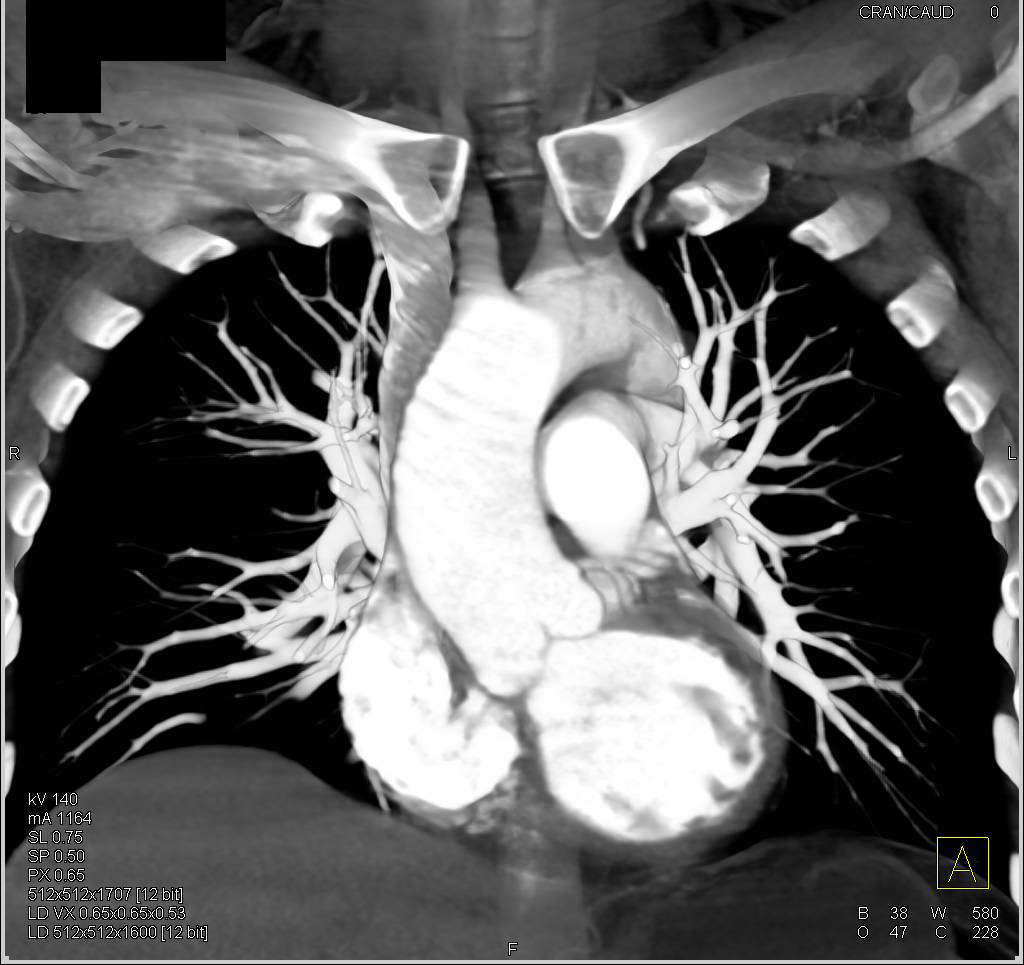 Dilated Aortic Root with Center Line Measurements - CTisus CT Scan