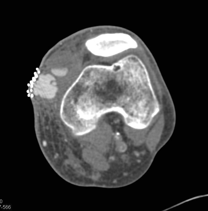 Pseudoaneurysm at Level of Knee - CTisus CT Scan