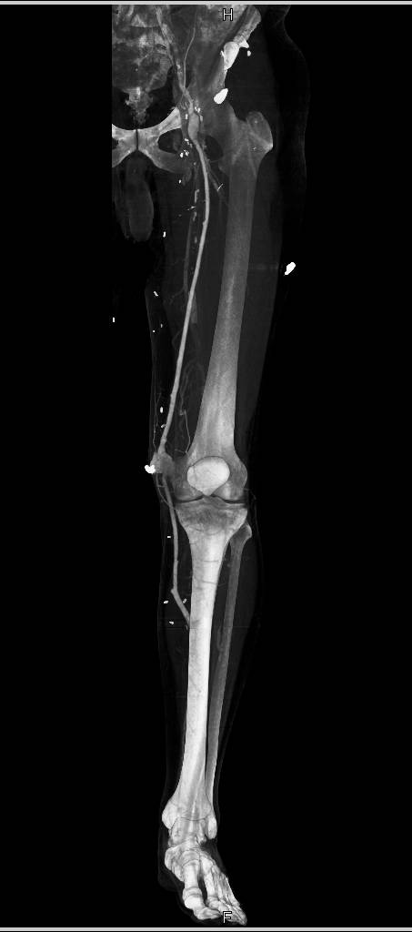 Pseudoaneurysm at Level of Knee - CTisus CT Scan